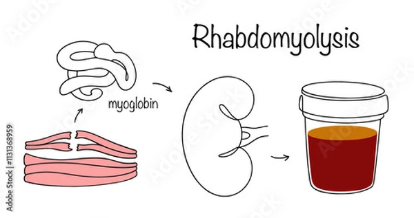 Obraz Rhabdomyolysis