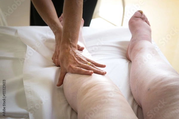 Fototapeta Terapista che esegue il massaggio linfodrenante  manuale su gambe con problemi di edema linfatico