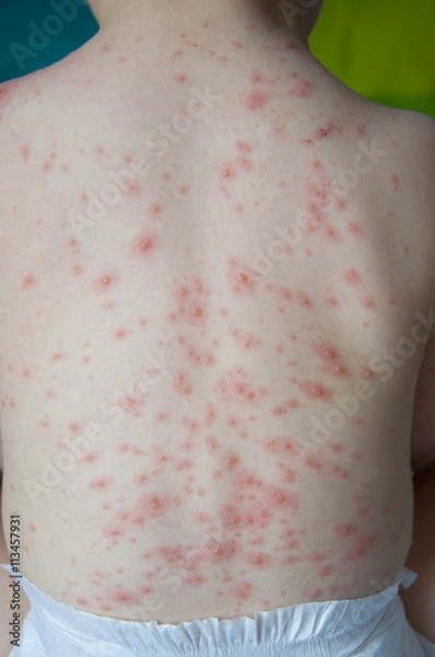 Obraz Chicken pox