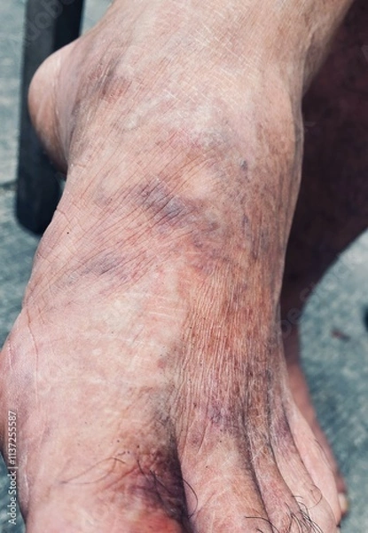 Obraz Varicose veins on feet caused by prolonged work hours. Image shows swollen veins on the feet due to standing or physical strain. Suitable for research on vein health and occupational impacts
