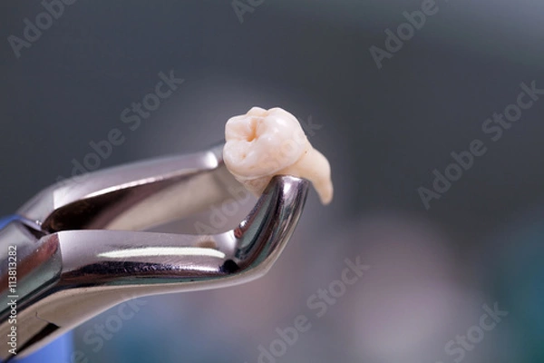 Obraz Sprzęt dentystyczny, ekstrakcja zębów