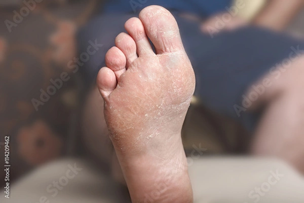 Obraz Foot psoriazis