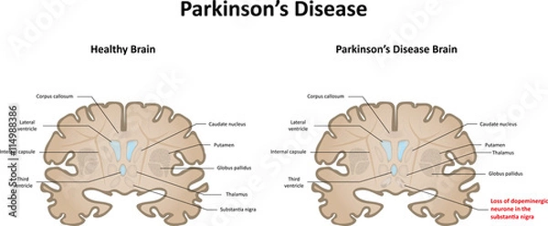 Fototapeta Parkinson's Disease