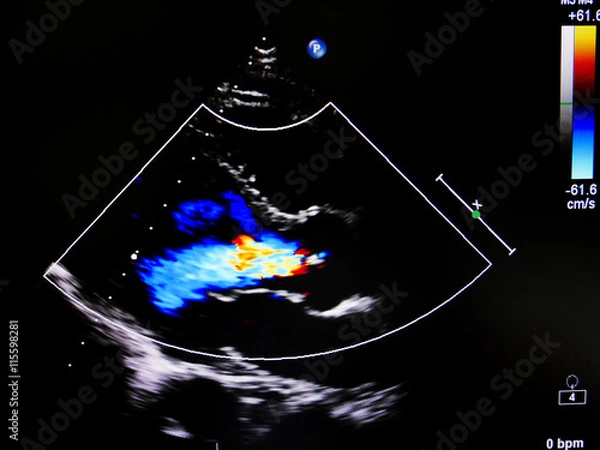 Obraz Flow color mode in echocardiogram