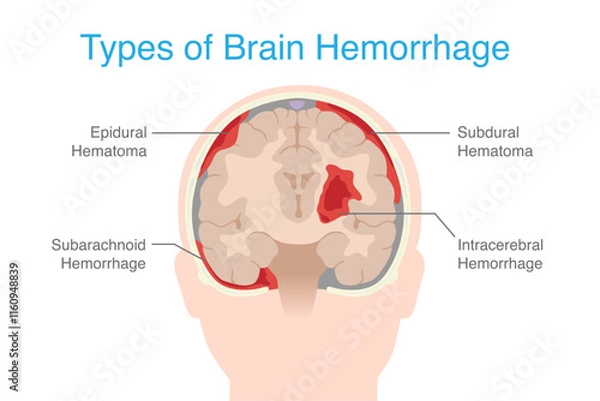 Fototapeta Types Brain hemorrhage inside skull of including Epidural hemorrhage, Subdural , Subarachnoid, and Intraparenchymal. Anatomy of human brain hemorrhage.