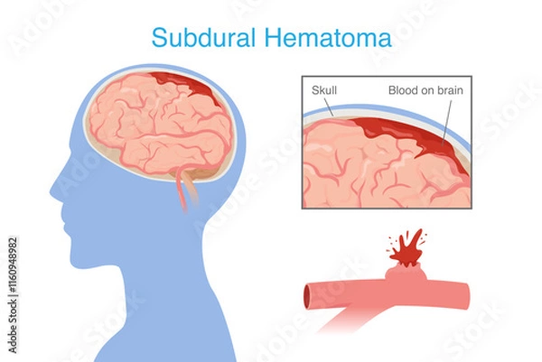 Fototapeta Subdural hematoma from head injury make bleeding into the brain area very rapidly and compressing brain tissue. Medical diagram.