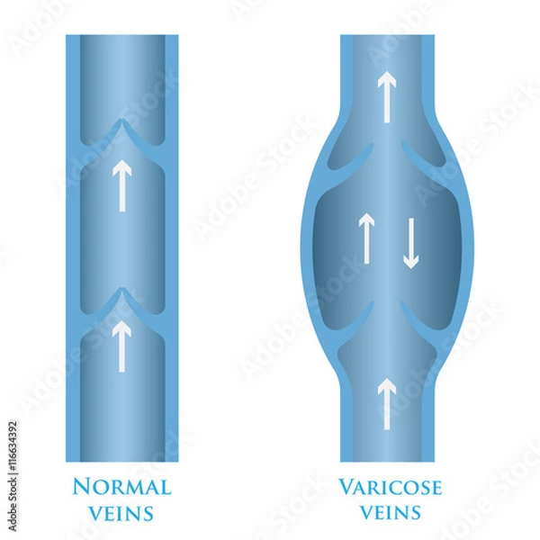 Obraz varicose veins