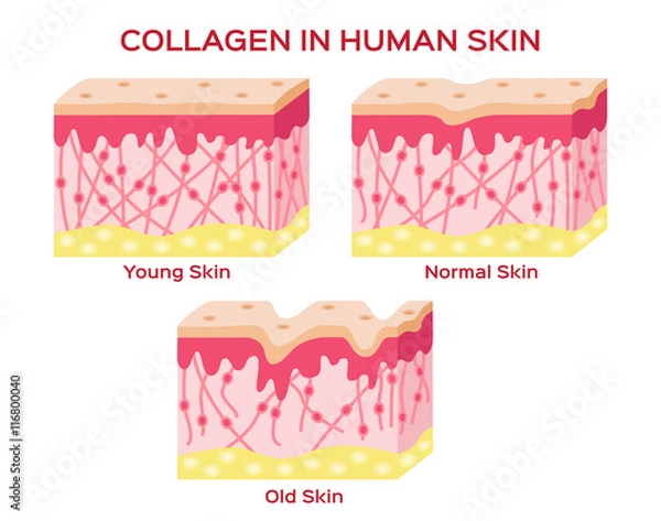 Fototapeta collagen in younger skin and aging skin , 3 type collagen skin version