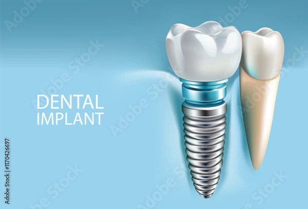 Fototapeta Dental implants on a light blue background, Vector illustration