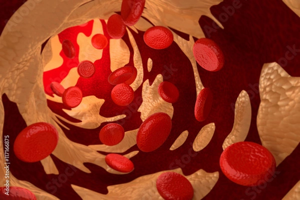 Obraz Arteriosclerosis by Cholesterol Plaque, 3D Rendering
