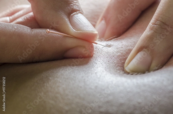 Fototapeta Closeup of a needle and hands of physiotherapist doing a dry needling.