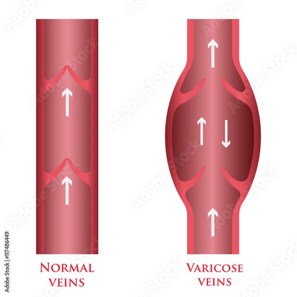 Obraz vector varicose veins