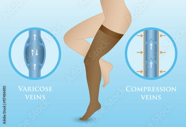 Obraz Medical compression hosiery