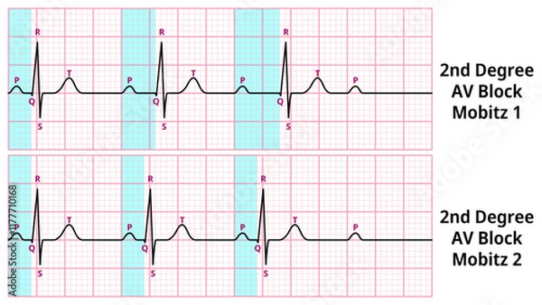 Fototapeta Comparison of AV Block Degree 2 Mobitz Type 1 and Type 2 ECG Waveforms - Medical Vector Illustration