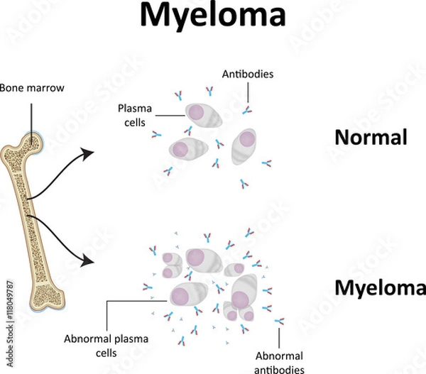 Obraz Myeloma