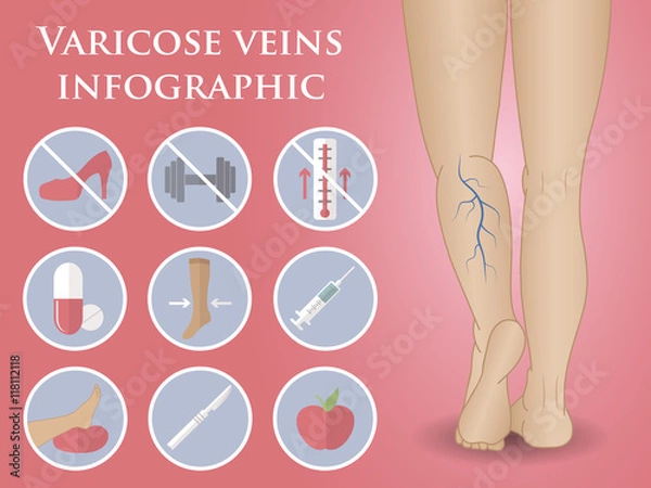 Obraz phlebology vector infographic