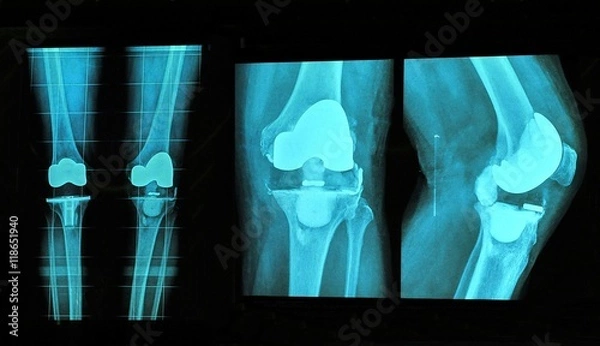 Obraz knee replacement xray