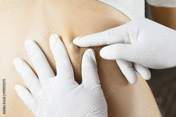 Obraz Doctor Diagnosis of the Sebaceous on Woman's Back