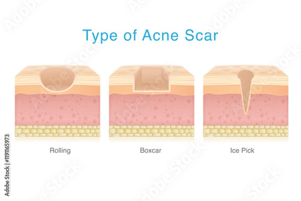 Fototapeta Types of acne scar on facial skin layer. Rolling, Boxed and Icepick scars isolated white background. 3D vector Medical diagram about skin problem from acne.