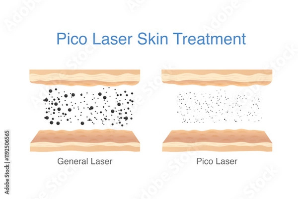 Fototapeta Reduce freckles, blemishes, wrinkles and spots by Picosecond Laser breaks down pigmentation in skin layer into smaller fragments. Medical laser called Pico.