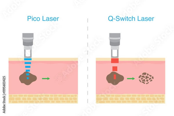 Obraz Compare the effect of Pico laser and Q switch laser on area skin layer. Laser treatment dark spot, Melasma, and scar.