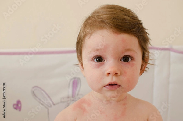 Obraz  Roseola infantum