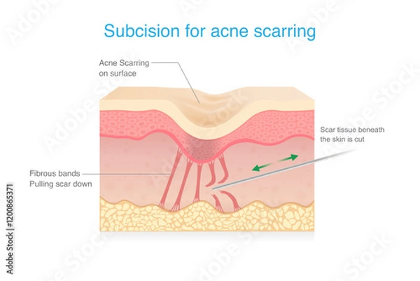 Obraz Subcision for Acne Scars treatment. Cut fibrous bands under skin layers tethered down within skin with small needle for treatment. Micro surgical technique.
