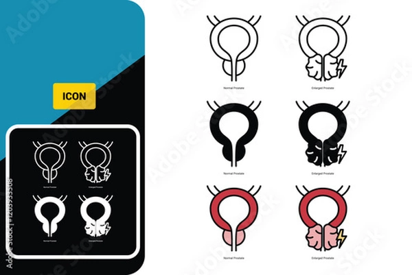 Obraz Normal prostate and benign pro-static hyperplasia. Bladder surgery urologist. Vector icon set