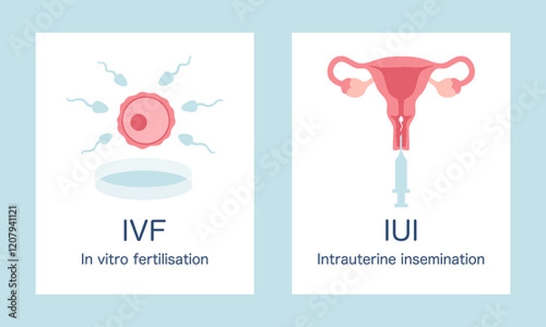 Fototapeta In vitro fertilization IVF and intrauterine insemination IUI infographic posters set. Egg, sperm, uterus and syringe illustration in cartoon flat style