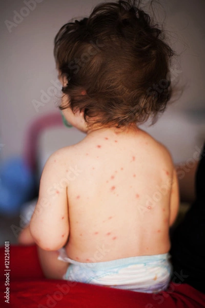 Obraz  Chicken pox