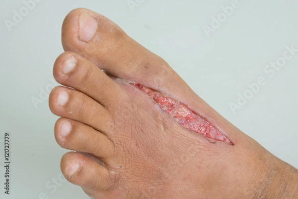 Obraz Open wounds on foot from centipede bite