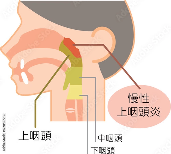 Obraz 慢性上咽頭炎の説明図・カラー・図解_イラスト