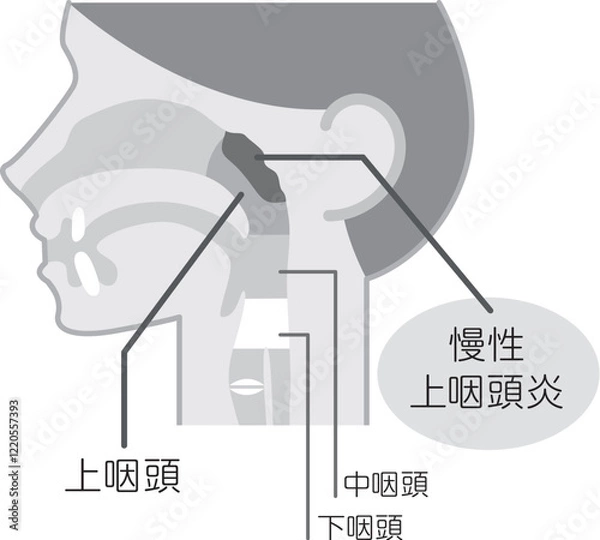 Obraz 慢性上咽頭炎の説明図・白黒・図解_イラスト