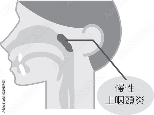 Obraz 慢性上咽頭炎の説明図・白黒・シンプルな図解_イラスト