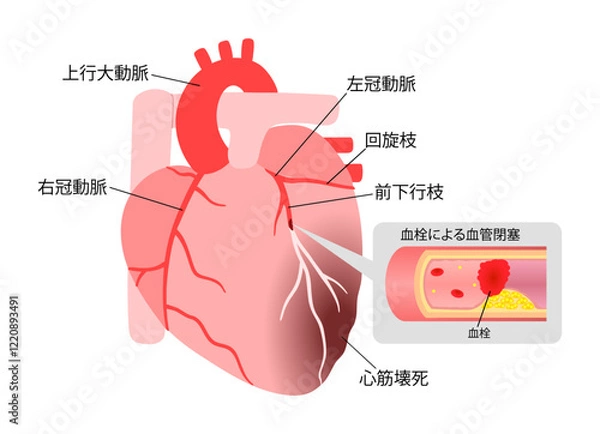Obraz 心筋梗塞を起こした心臓の血栓の説明入りイラスト