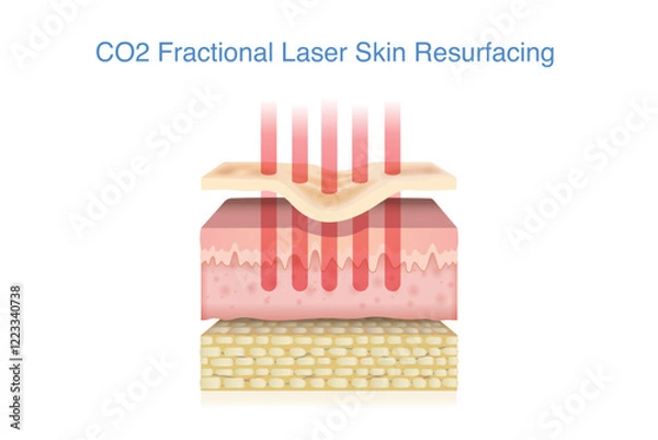 Fototapeta Skin layer with  acne scar treated by CO2 fractional laser into middle layer. 3D illustration about technology for healing scars and reduce wrinkles.