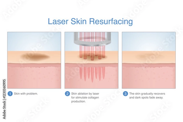 Fototapeta Laser skin resurfacing in 3 Step3. Skin with dark spots, freckles and scar on surface faded after treating with laser energy deep in the skin layer.