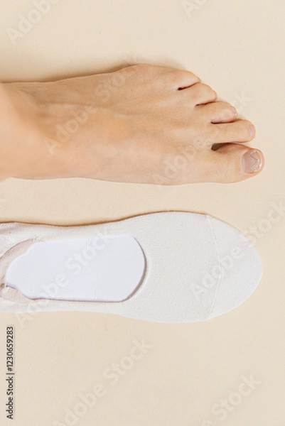 Fototapeta foot with ingrown nail and insole in the background. Concept of ingrown nail, onychocryptosis. Non-surgical correction of ingrown nail, Podofix correction systems