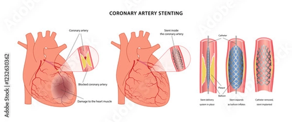 Obraz Angioplasty with stenting on the heart. Medical illustration of the steps of angioplasty of blood vessels, as well as a diseased heart before and after surgery. Vector illustration in a flat style.