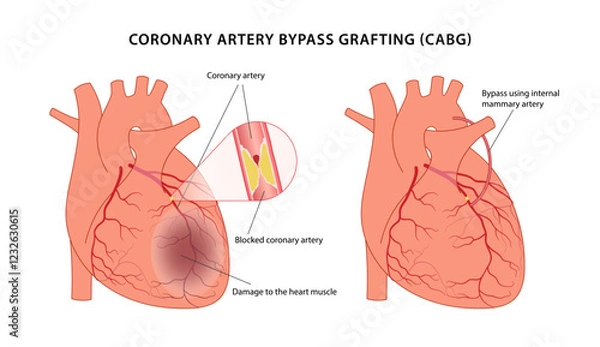 Obraz Coronary artery bypass grafting (CABG). Medical illustration of bypass surgery of a diseased heart using the internal mammary artery. Vector illustration in a flat style