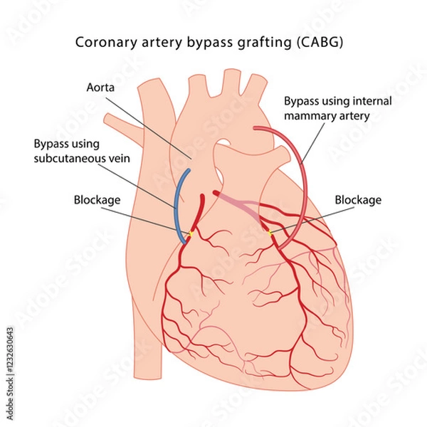 Obraz Coronary artery bypass grafting (CABG). Medical illustration of bypass surgery of a diseased heart using the internal mammary artery and the vein of the lower leg. Vector illustration in a flat style