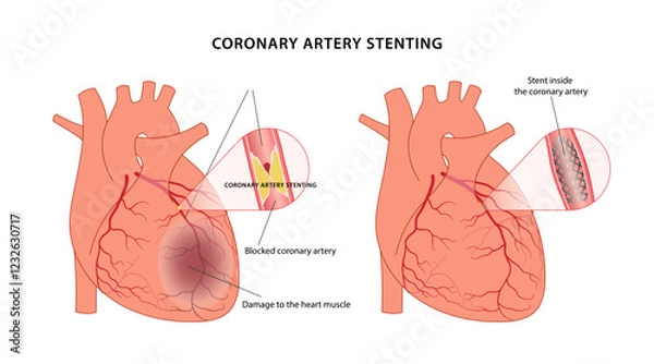 Obraz Angioplasty with stenting on the heart. Medical illustration of a sick heart before and after surgery. Vector illustration in a flat style.