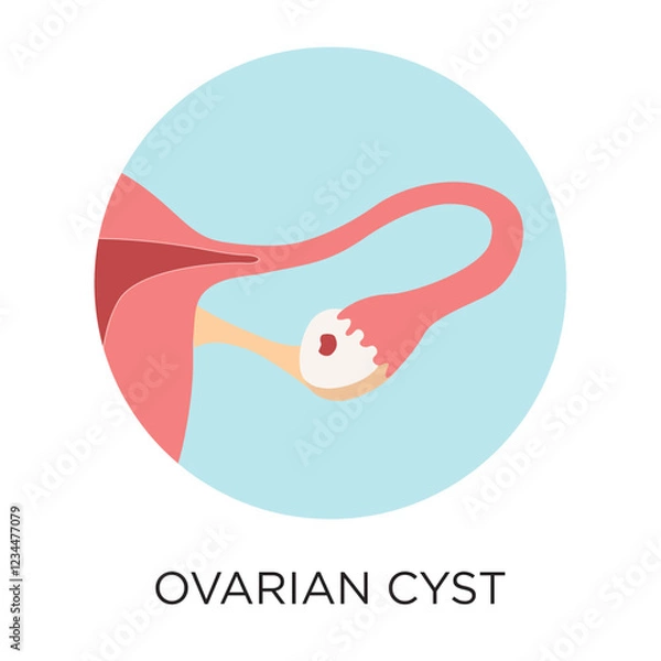 Obraz Vector Ovarian Cyst Icon