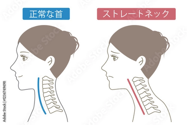 Obraz ストレートネック　ビフォアアフター