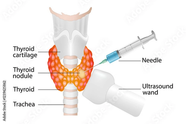 Obraz Fine needle aspiration biopsy of the thyroid gland
