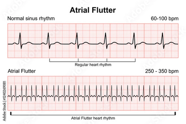 Fototapeta Atrial Flutter heart rhythm illustration