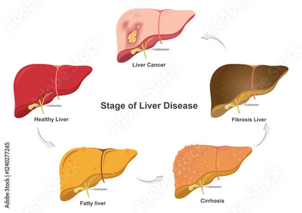 Obraz Stage of liver damage.