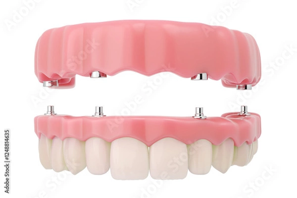 Obraz full mouth dental implant with screw-supported denture, Front view.