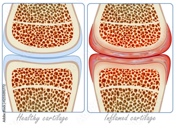 Fototapeta A diagram illustrating inflammation in the joint caused by rheumatoid arthritis can be seen and compared with half of the image of a healthy joint.