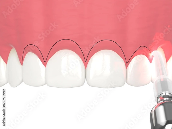 Fototapeta 3d render of upper jaw treated with laser for gummy smile. Creating a new gum line by gingivectomy.